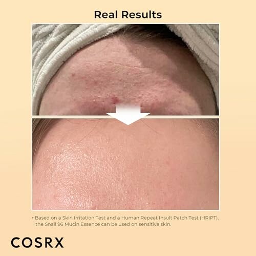 Before and after skin treatment showing improved forehead texture.