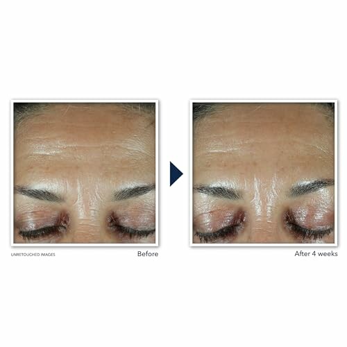 Comparison of forehead wrinkles before and after 4 weeks of treatment.