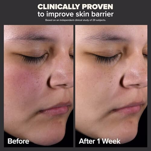 Side by side comparison showing skin improvement over one week.