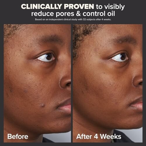 Comparison of skin before and after 4 weeks showing reduced pores and oil control.